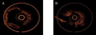 Novel image features of optical coherence tomography for pathological classification of lung cancer: Results from a prospective clinical trial